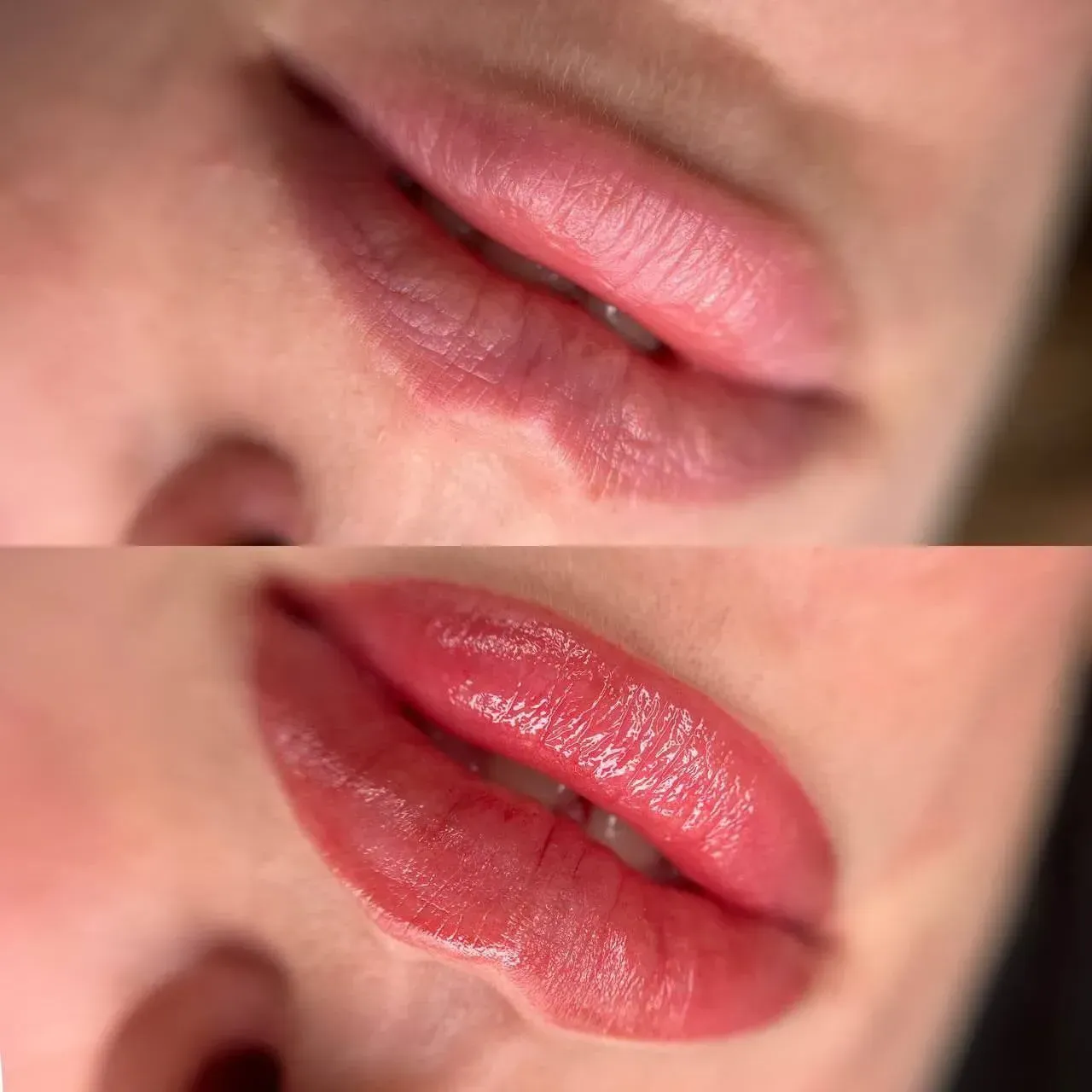 Результат процедури для губ — до і після в Miss Daisy