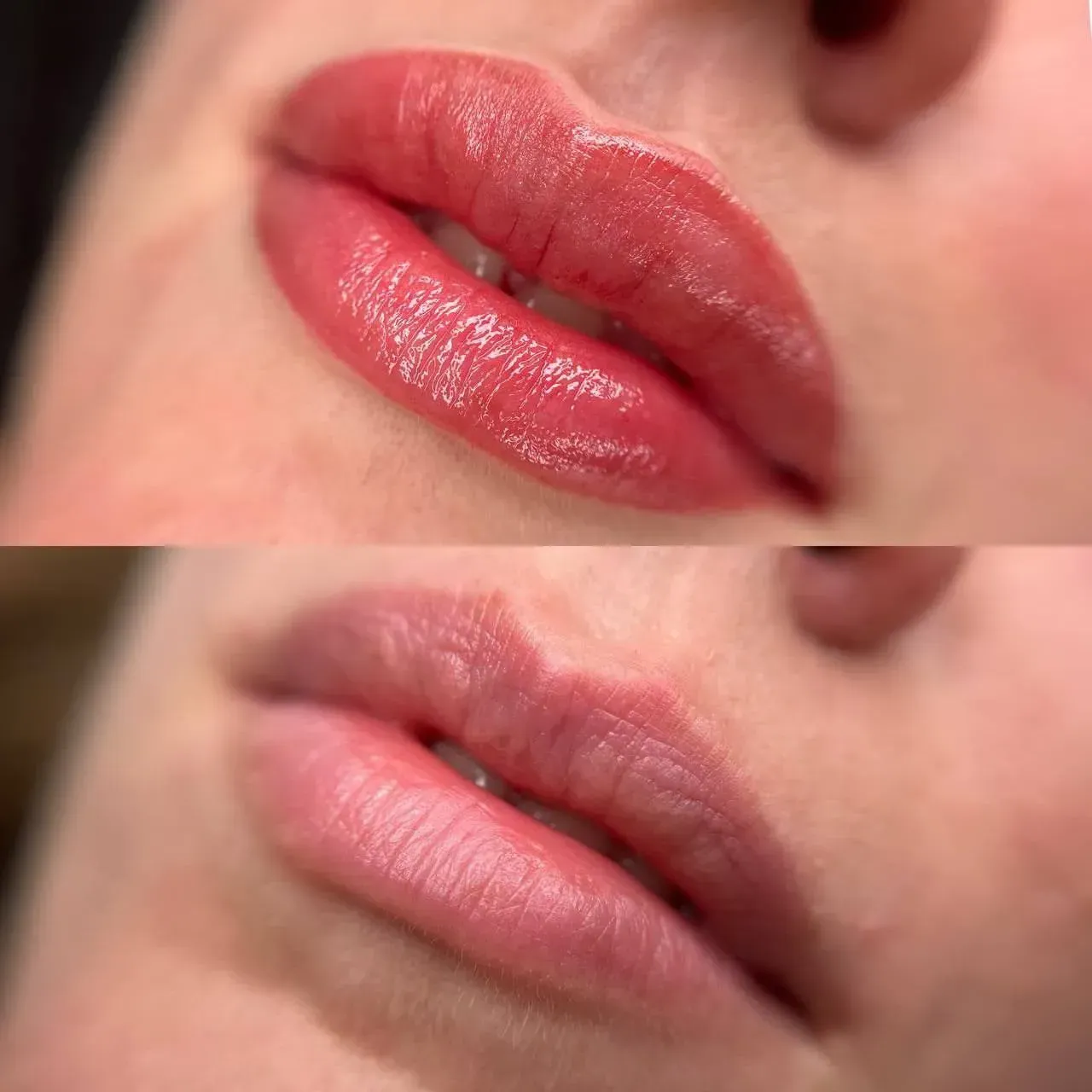 До та після процедури для губ